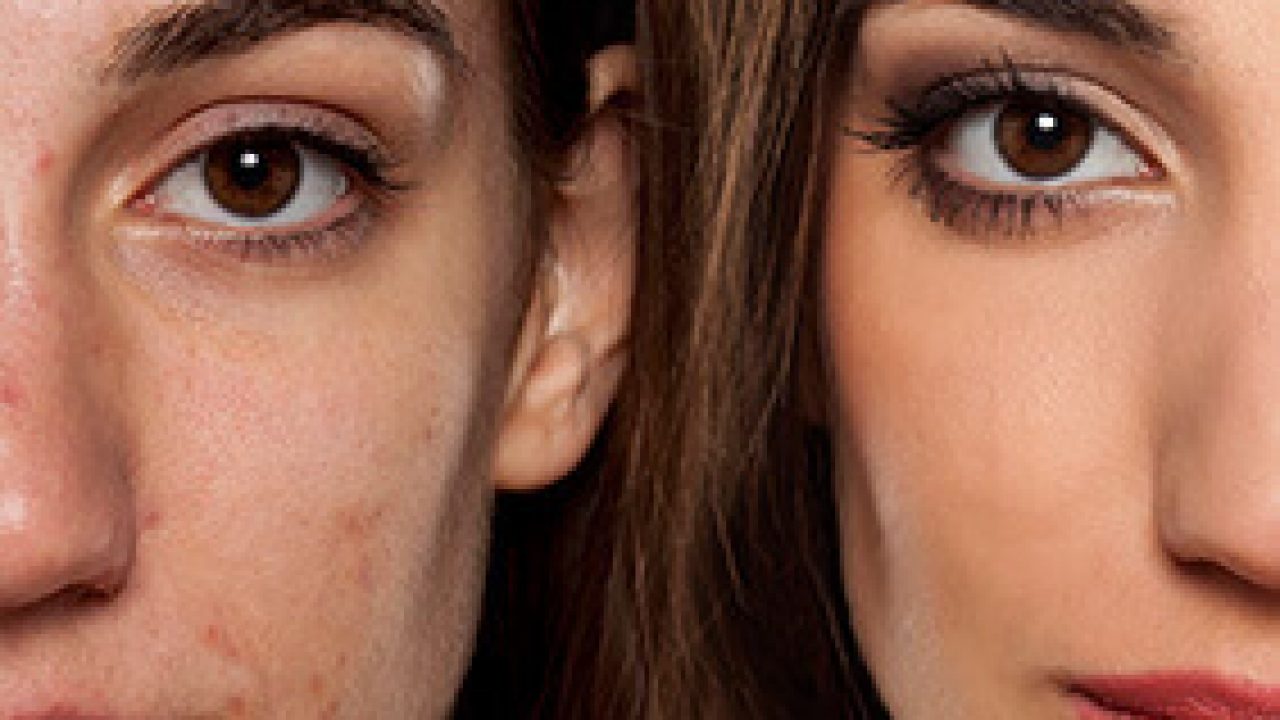 acne treatment mississauga