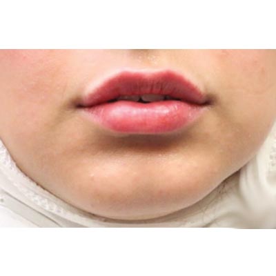 After Lip Filler Treatment - 3