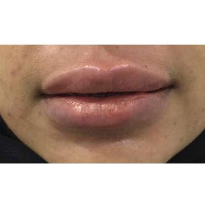 After Lip Filler Treatment - 6